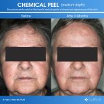 After_chemical_peel_dealing_with_bumps_on_your_face