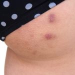Boil_on_butt_remedy_effective_solution_for_treating_infected_pores