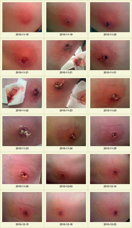 Brown Recluse Spider Bite Timeline_ Pictures
