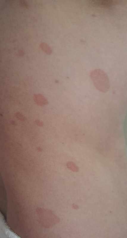 Big Red Spots on Skin Not Itchy