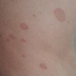 Big_red_spots_on_skin_not_itchy