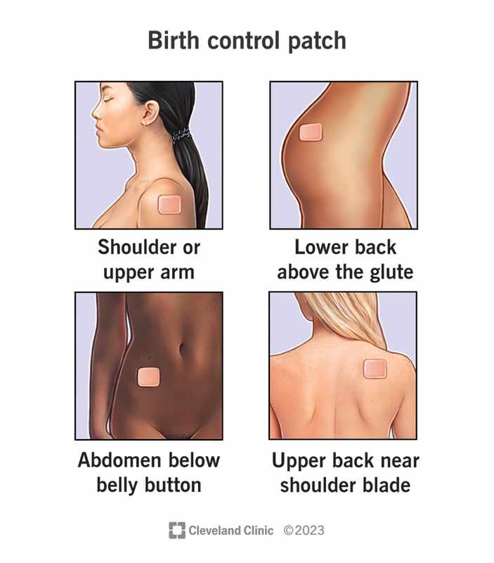 Birth Control Patch Review