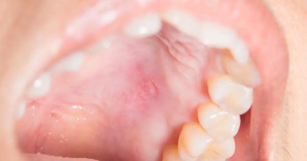 Bump On Roof Of My Mouth