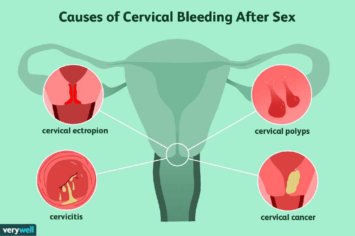 Causes of Vaginal Bleeding After Sex