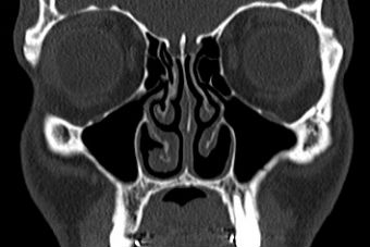 Chances of Getting Empty Nose Syndrome