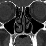 Chances_of_getting_empty_nose_syndrome