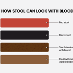 Signs_of_a_lot_of_blood_in_my_stool_what_does_it_mean