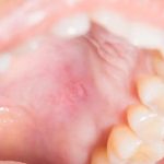 Two_bumps_on_roof_of_mouth