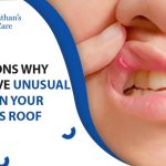 2_bumps_on_roof_of_mouth