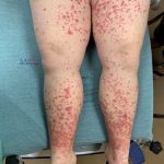 32_weeks_pregnant_with_itching_red_spot_on_eyeball_and_swollen_legs_ankles