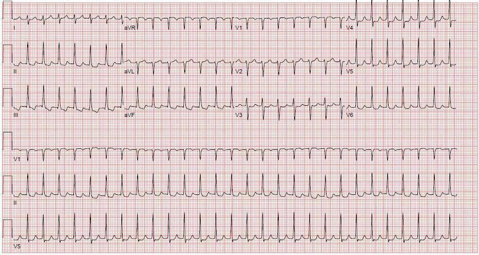 AFib with RVR EKG Strip_ A Comprehensive Guide