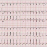 Afib_with_rvr_ekg_strip_a_comprehensive_guide