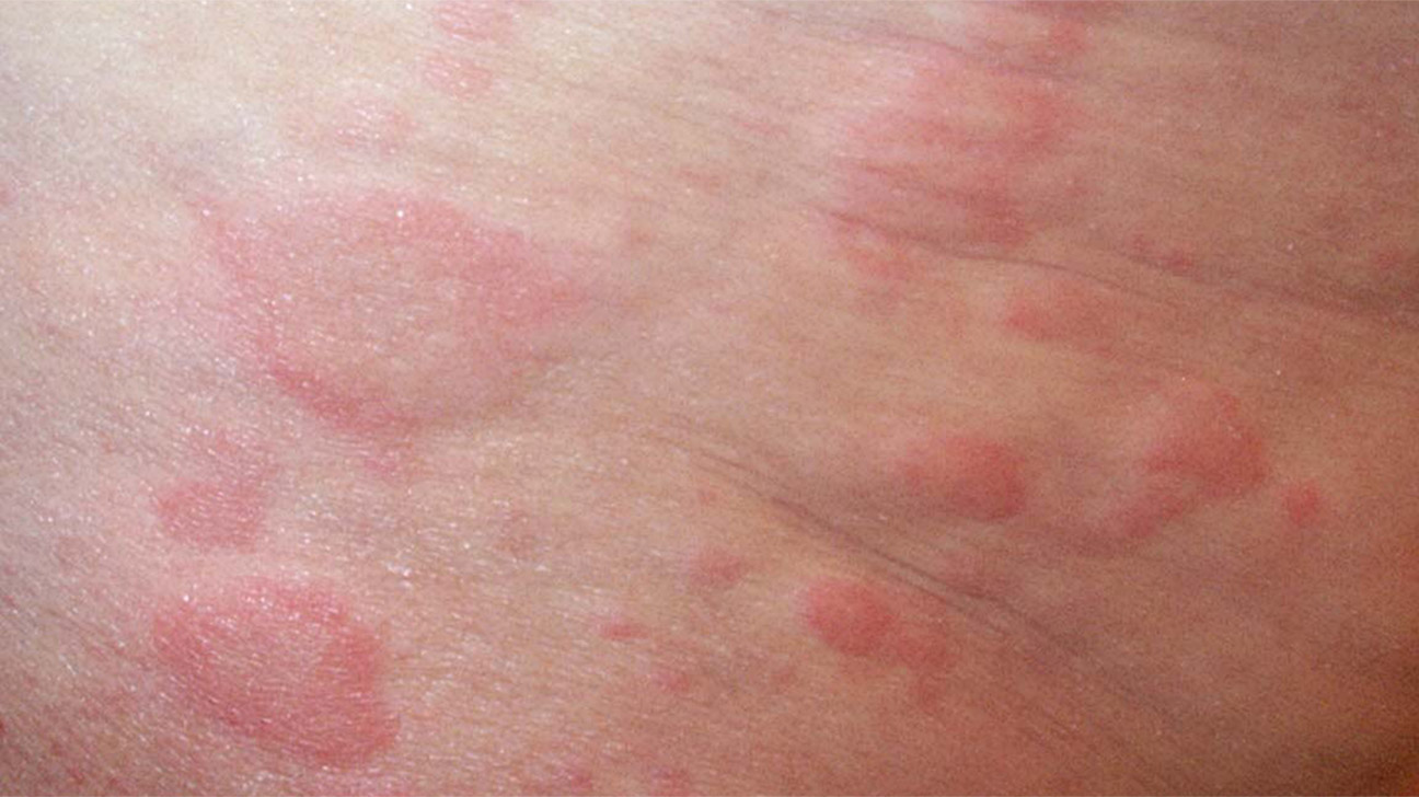 Allergic Rash Caused by Cat Allergies