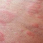 Allergic_rash_caused_by_cat_allergies