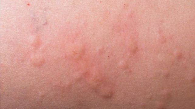 Amoxicillin Clavulanate_ Side Effects