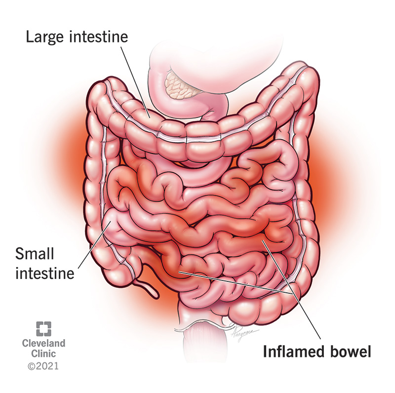 An Inflammation of the Stomach and Small Intestine is Known As