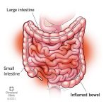 An_inflammation_of_the_stomach_and_small_intestine_is_known_as