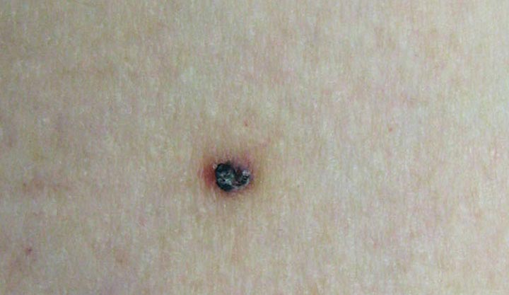 Angiokeratoma of Fordyce Spots