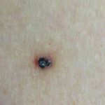 Angiokeratoma_of_fordyce_spots