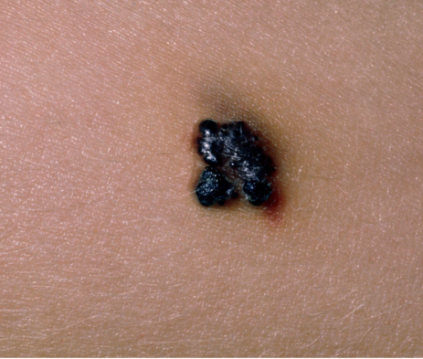 Angiokeratomas of Fordyce_ Solitary Treatment