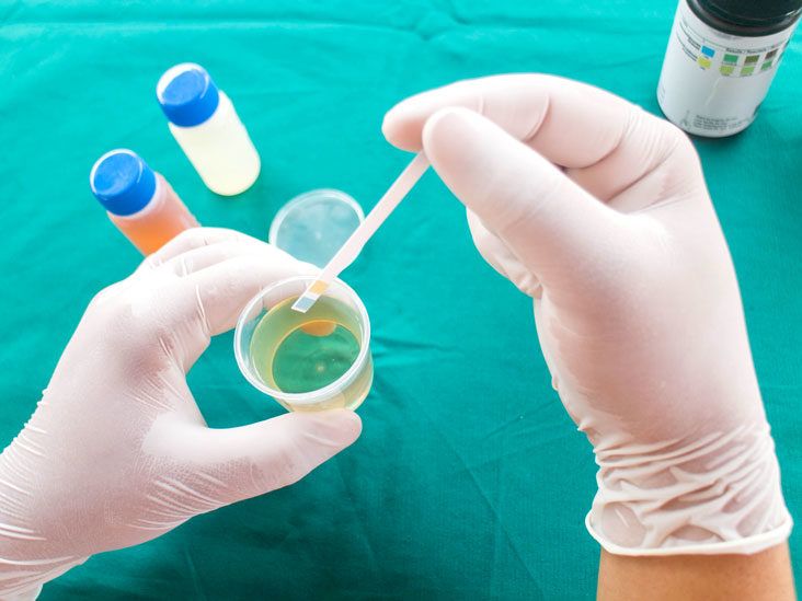 Are Urine Bilirubin Tests Accurate_