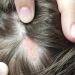 Baby Born With Bald Spot On Head_1