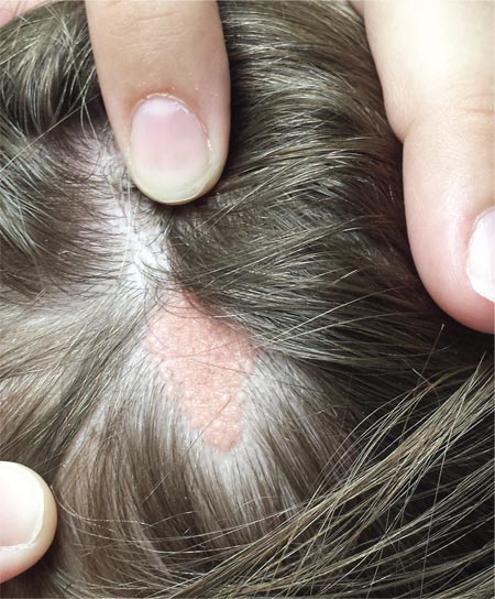 Baby Born With Bald Spot On Head