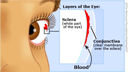Baby Poked Eye Red Spot