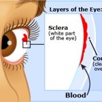 Baby_poked_eye_red_spot