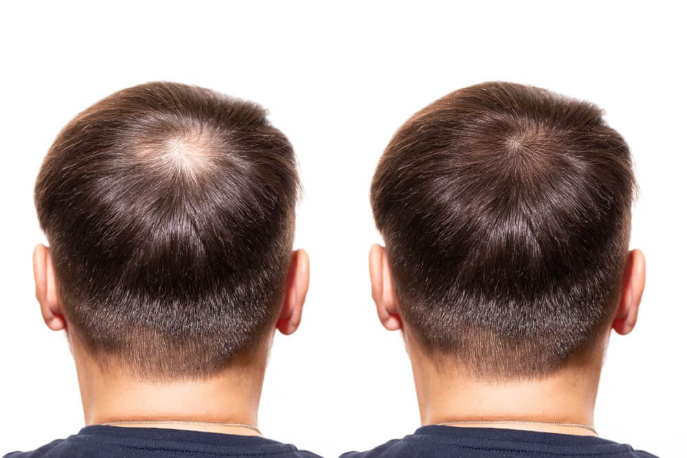 Best Hairstyle for Bald Spot on Back of Head