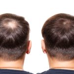 Best_hairstyle_for_bald_spot_on_back_of_head