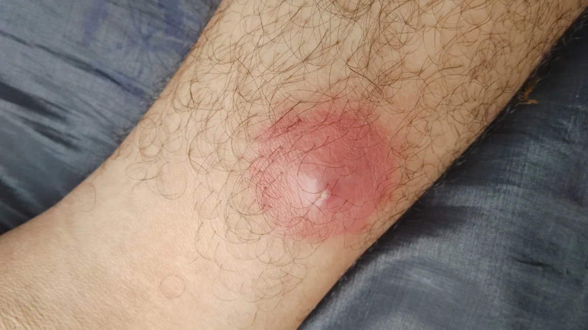 Big Red Itchy Bumps On Hands