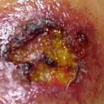 Bites_of_brown_recluse_spider