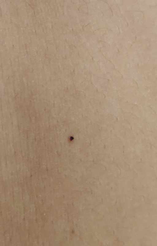 Black Spots Suddenly Appearing on Skin
