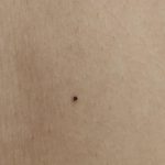 Black_spots_suddenly_appearing_on_skin