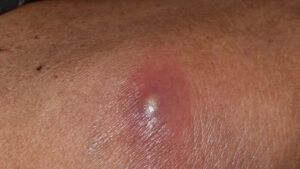 Boil On Butt Cheek Treatment