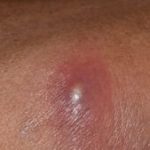 Boil_on_butt_cheek_treatment