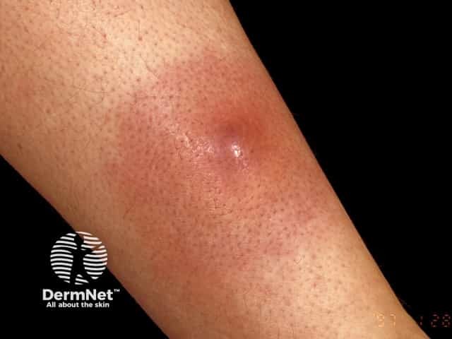 Boils On Butt Iodine_ Effective Treatment Options