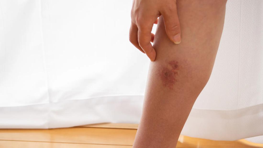 Bug Bite Turning into Cellulitis_ A Serious Complication