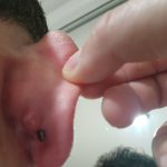 Bump_behind_ear_lobe_piercing
