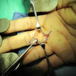 Bump_on_inside_of_finger_joint