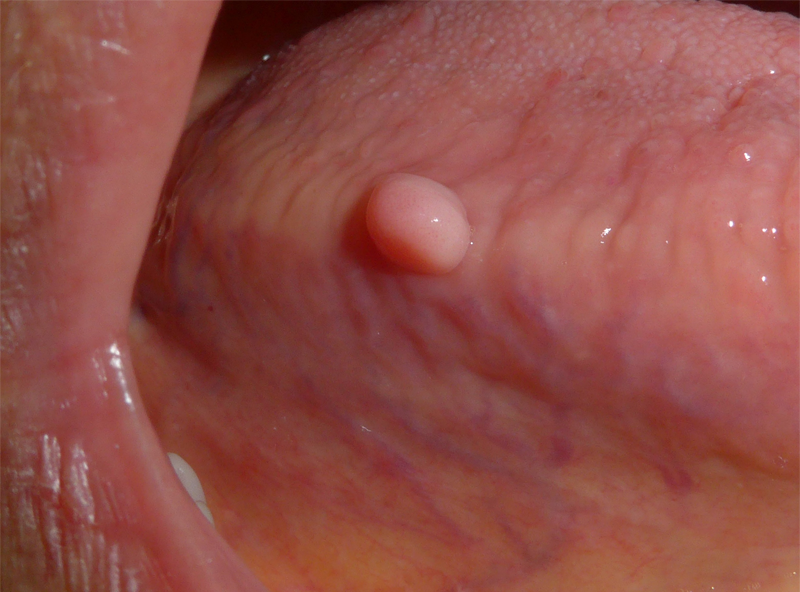 Bumps In My Mouth