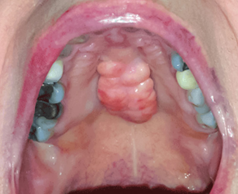 2 Bumps On Roof Of Mouth