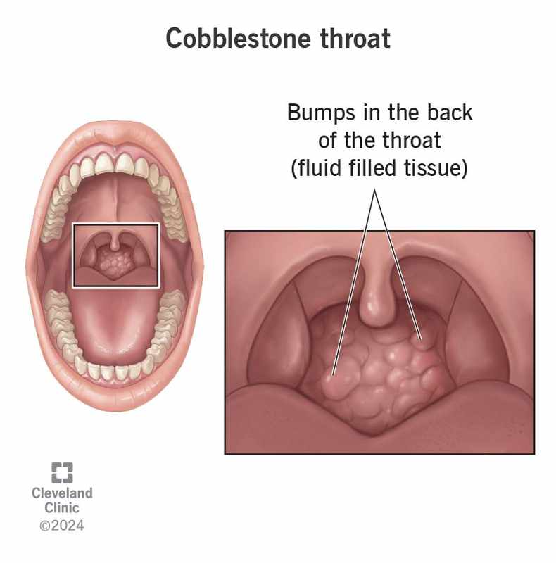 Bumps in Back of Mouth