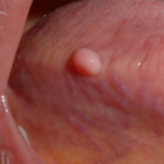 Bumps_in_my_mouth