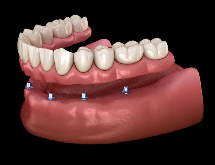 Can I Ask My Dentist to Remove All My Teeth_