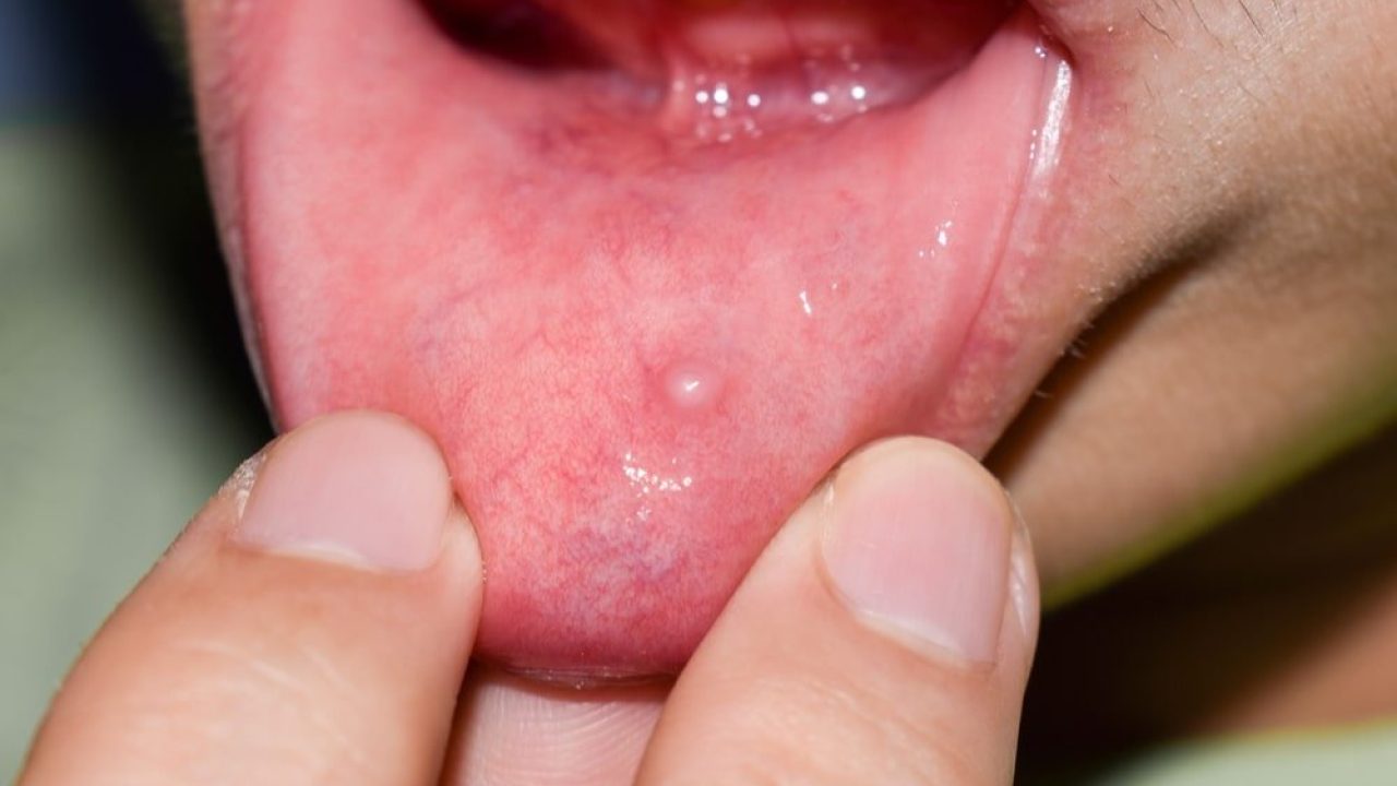 Can You Get A Pimple Inside Your Mouth
