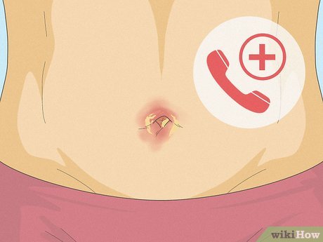 Can You Get a Yeast Infection in Your Belly Button_