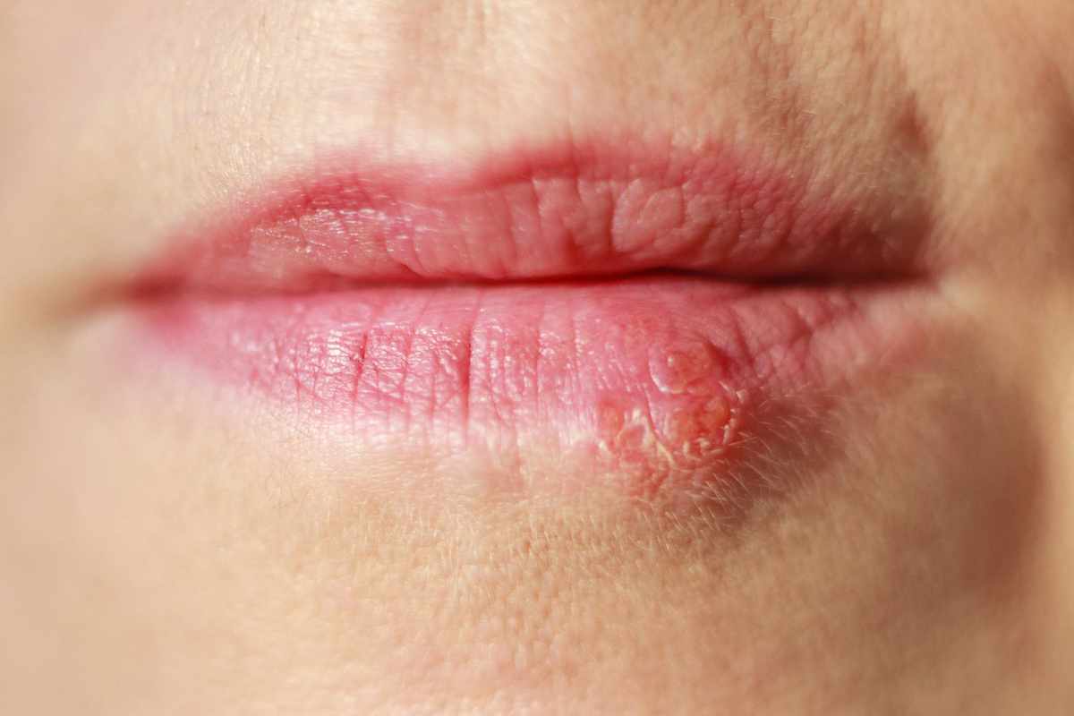 Can You Have Sex With A Cold Sore_