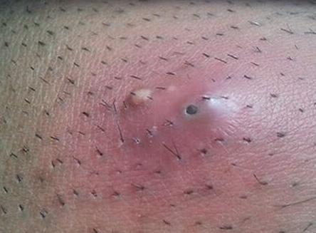 Can You Have Sex With Ingrown Hair Bumps